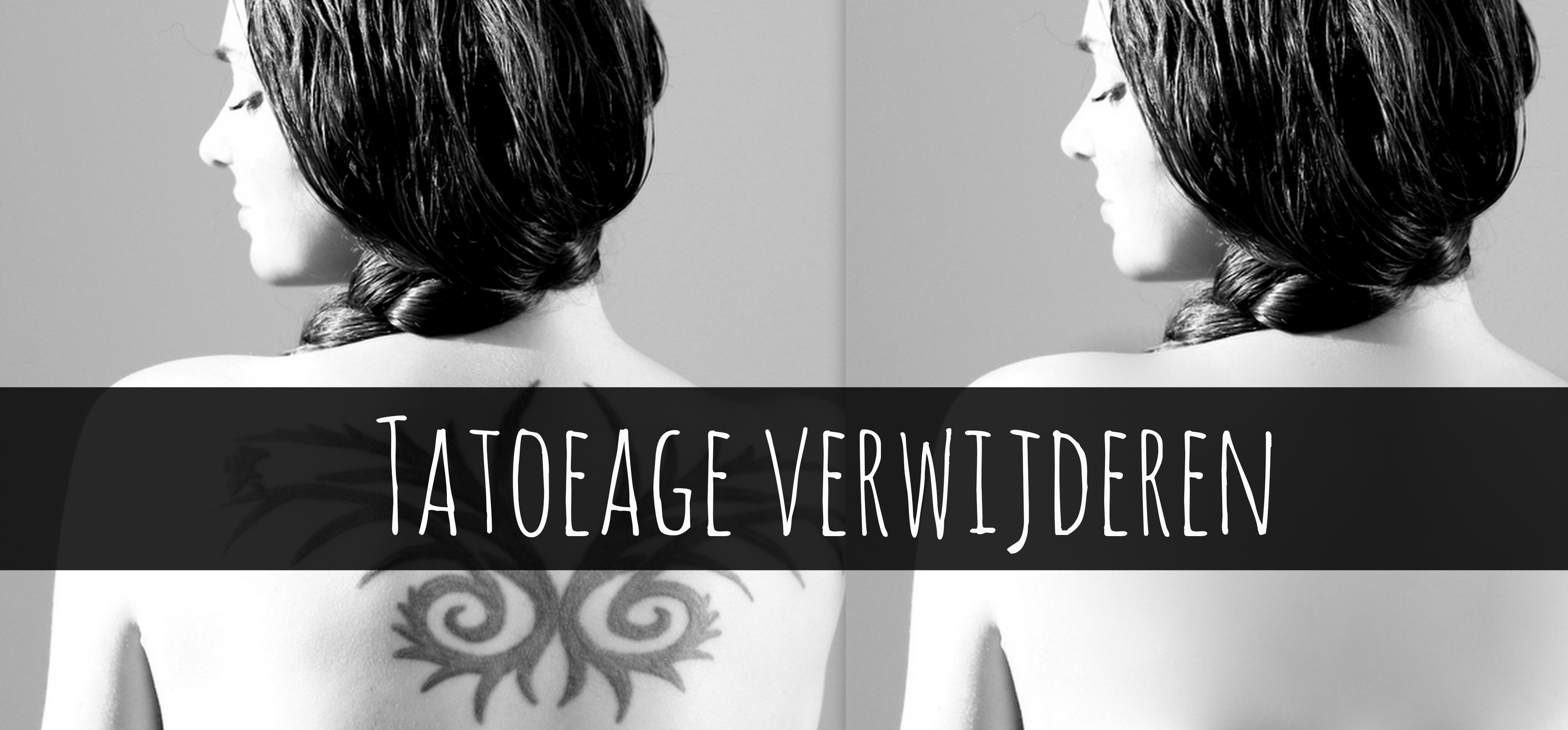 tatoeage verwijderen