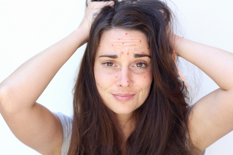 acne puistjes pukkels