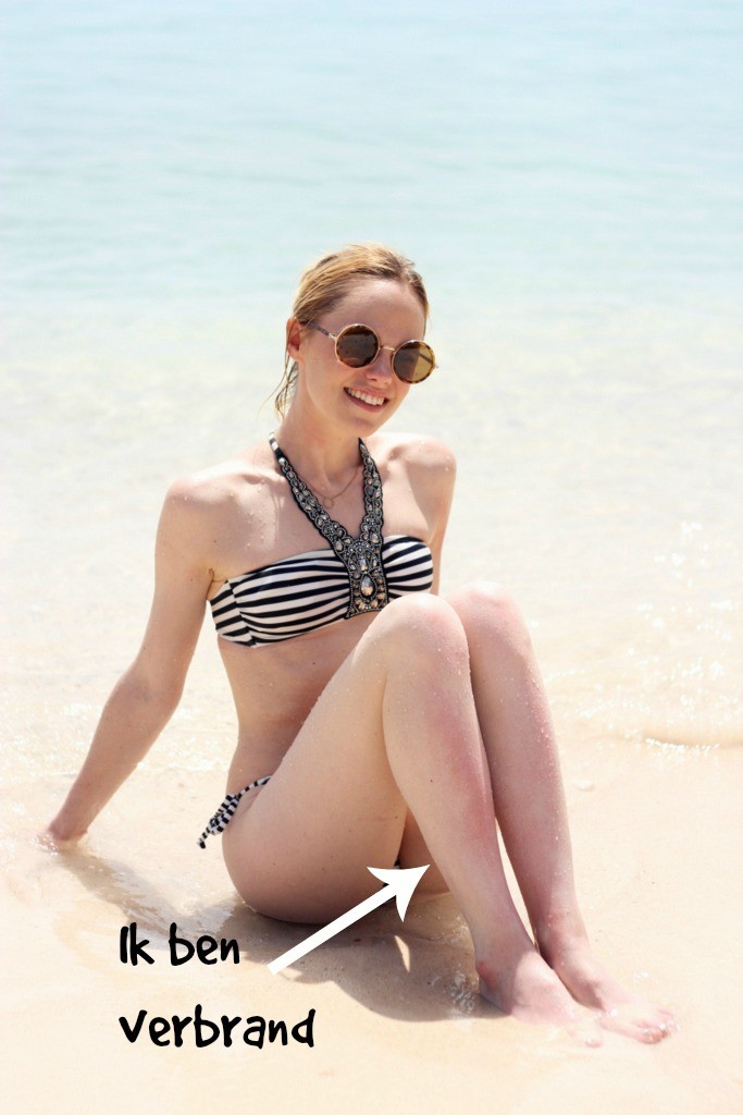 verbrand bikini